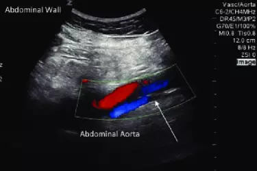 abdominal colour doppler, abdominal aortic aneurysm, colour doppler of aorta, cost of colour doppler of the abdominal aorta, best radiologist for colour doppler abdomen, best diagnostic centre in gurgaon