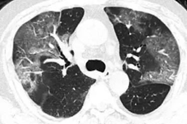 best diagnostic centre for ct chest, best diagnostic centre in gurgaon, hrct chest in gurgaon, ct scan of lungs in gurgaon, cect chest in gurgaon, cost of ct scan chest in gurgaon, best test for covid-19 in gurgaon