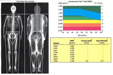 Dexa Scan in Gurgaon, Bone Mineral Density Test in Gurgaon, BMD Test in Gurgaon, Body Fat Analysis Test in Gurgaon, BMD Test at EHL Diagnostics Gurgaon, Cost of BMD test in Gurgaon , Cost of Bone Mineral Density Test in India