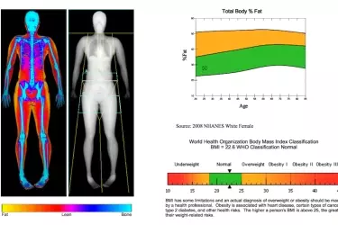 Dexa Scan in Gurgaon, Bone Mineral Density Test in Gurgaon, BMD Test in Gurgaon, Body Fat Analysis Test in Gurgaon, BMD Test at EHL Diagnostics Gurgaon, Cost of BMD test in Gurgaon , Cost of Bone Mineral Density Test in India