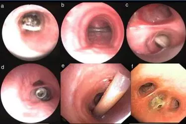 best doctor for endoscopy in gurgaon, best gastroenterologist in india, best doctor for colonoscopy in gurgaon india, best doctor for arthroscopy, best doctor for colposcopy, best doctor for ERCP, best doctor for bronchoscopy