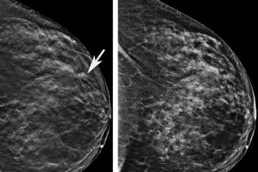 Mammography in Gurgaon, Cost of Mammography in Gurgaon, Mammography Test for Breast Cancer, Best Diagnostic Centre in Gurgaon, EHL Diagnostic Centre, Appointment:+91-8800188335