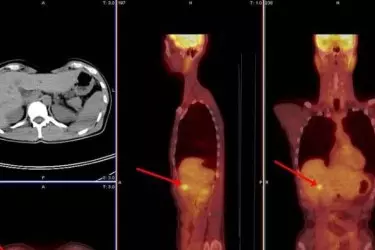 PET CT Centre in Gurgaon, Delhi, India, Cost of PET CT