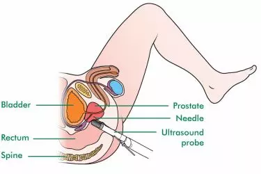 transrectal ultrasound (trus) in gurgaon, cost of trus ultrasound in gurgaon, ultrasound for prostate cancer in gurgaon, ultrasound for colon cancer in gurgaon